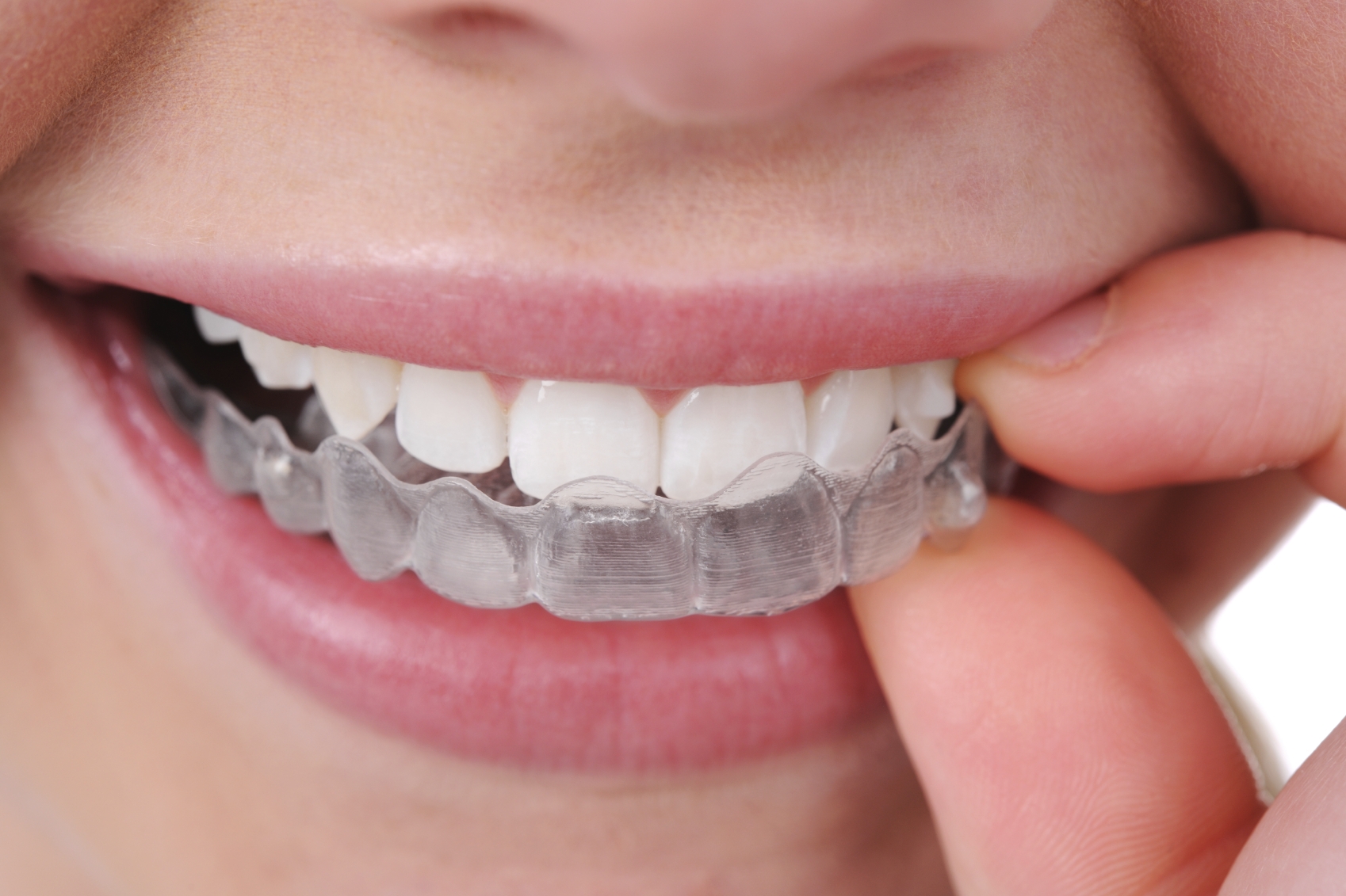 Invisalign Braces Clear Braces Lawrence MA Methuen MA, Boxford MA